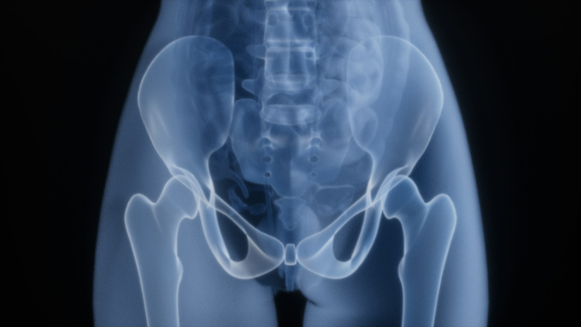 osteoporóza, rontgen